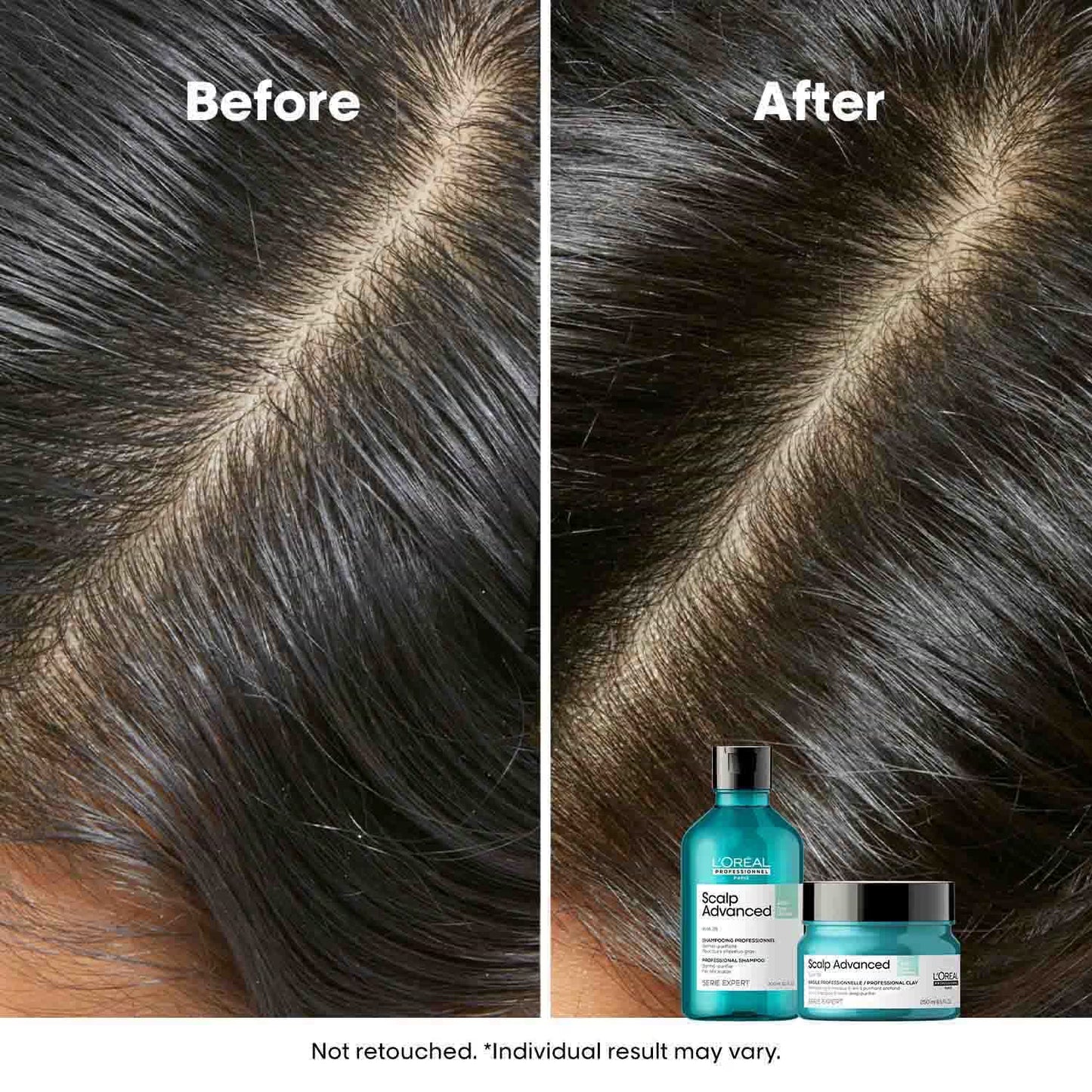 L'OREAL PROFESSIONNEL Scalp Advanced Anti-Oiliness Dermo-Purifier Shampoo (300 ml) for Oily Scalps