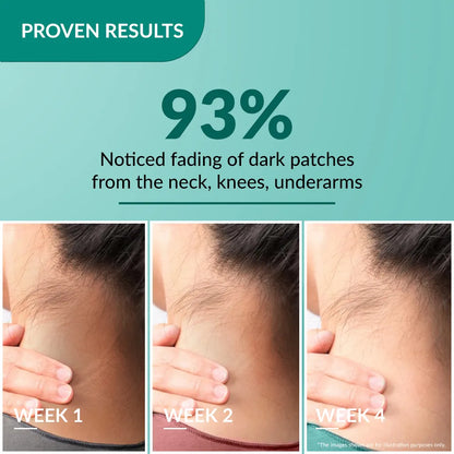 Fix Derma  Nigrifix Cream | A patented solution to treat hyperpigmentation(100g)